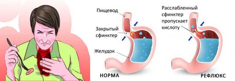 Что делать при изжоге и как от нее избавиться