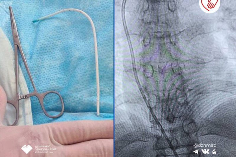 В ХМАО спасли пациентку с частью катетера в сердце